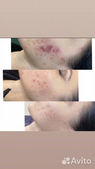 Лазерная эпиляция Фотоэпиляция Удаление тату