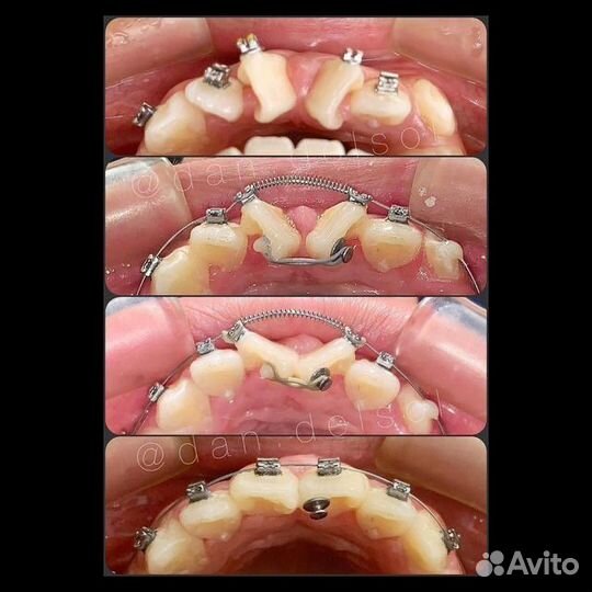 Ищу модель на брекеты