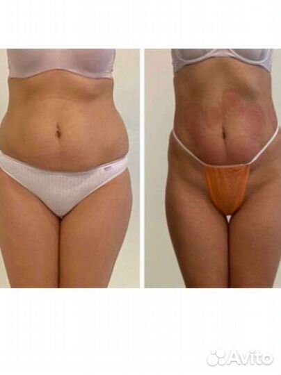 Аппаратный массаж, жиротоп