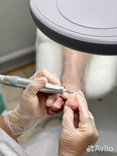 Подолог. Педикюр. Вросший ноготь. Мозоли. Грибок