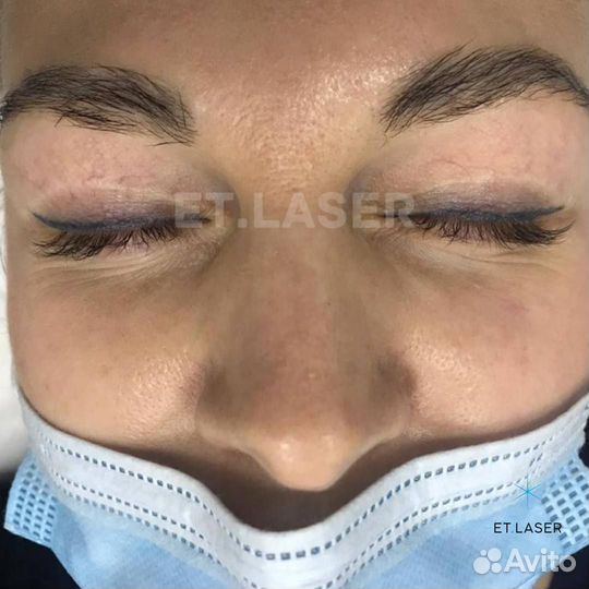 Удалить татуаж