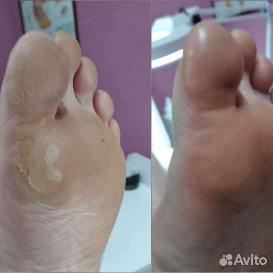 Аппаратный педикюр