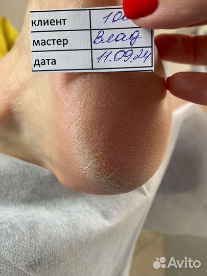 Подологический педикюр