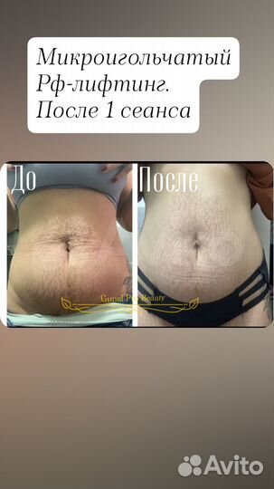 Микроигольчатый Рф-лифтинг