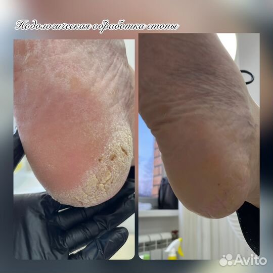 Подология/ Педикюр