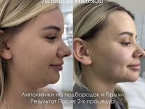 Косметолог: худое лицо/ сужение носа/ липолитики