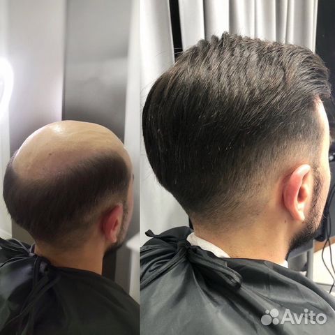 Мужская система волос, 