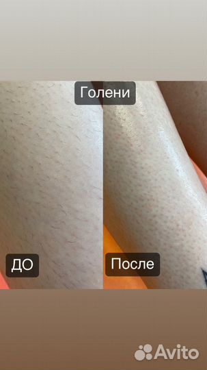 Шугаринг Зеленоград