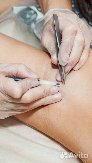 Электроэпиляция модель