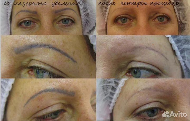 Удаление перманентного макияжа