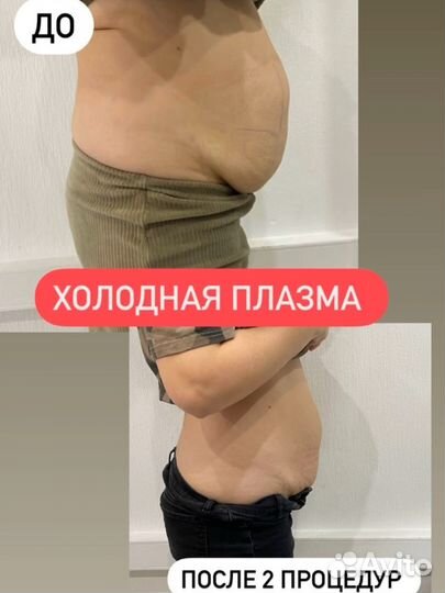 Холодная плазма