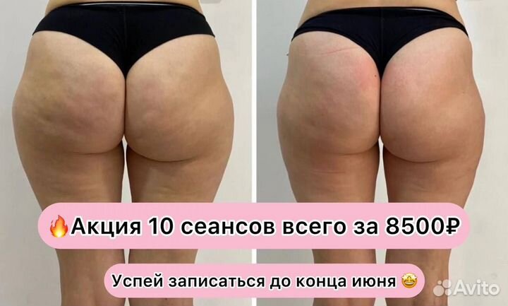 Аппаратный массаж. Антицеллюлитный. Коррекция фигу