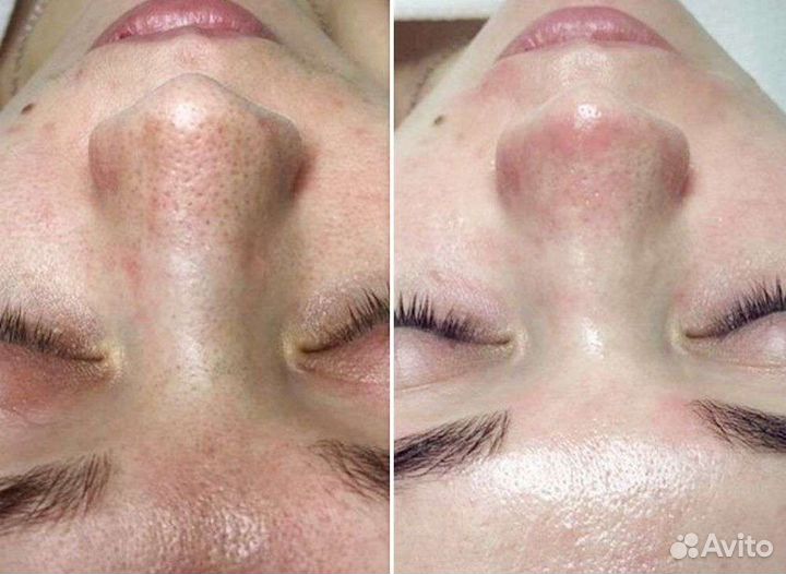 Комбинированная чистка лица