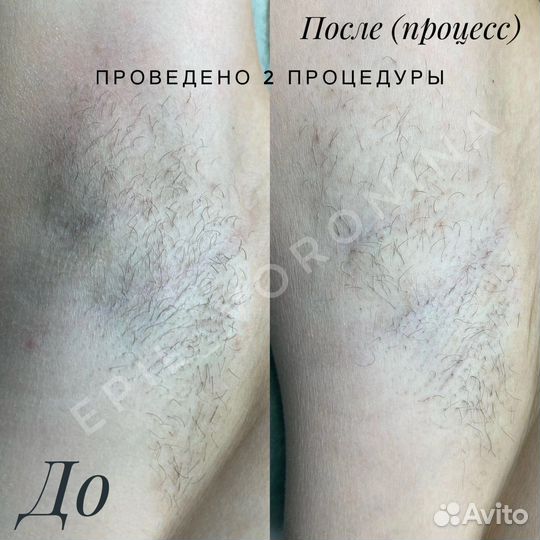 Электроэпиляция