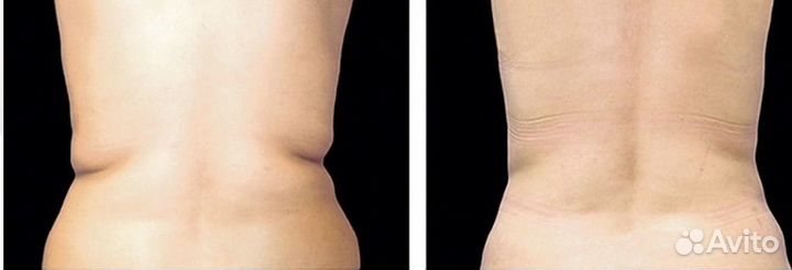 Криолиполиз (Похудение)