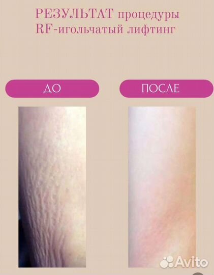Rf игольчатый аппаратное омоложение в СПБ