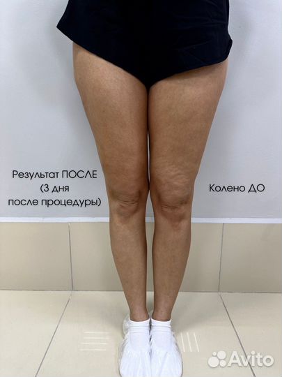 Массаж LPG / Vela Shape