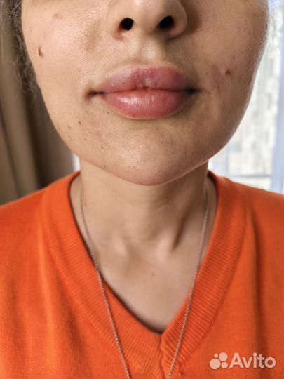 Увеличение губ