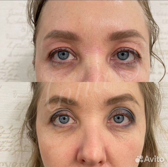 Холодная плазма, подтяжка лица, шеи и век