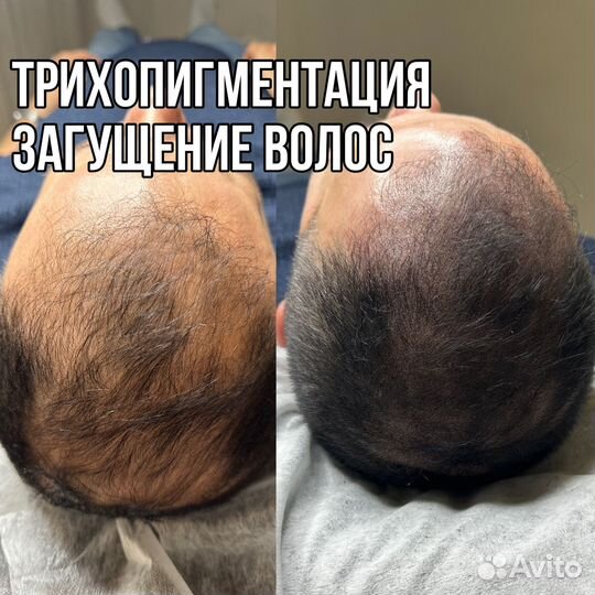 Трихопигментация головы