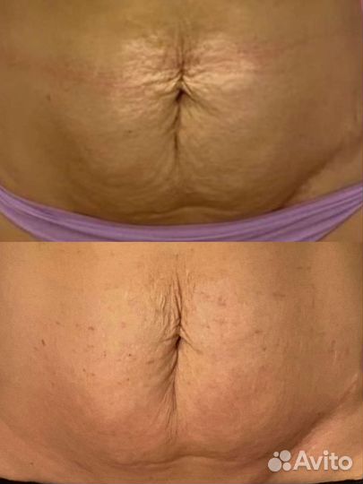 Модели на шлифовку удаление шрамов омоложение