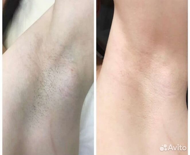 Лазерная эпиляция