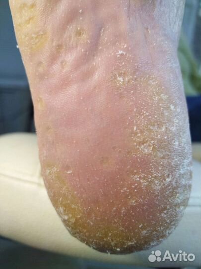 Медицинский педикюр подолог