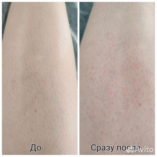 Электроэпиляция