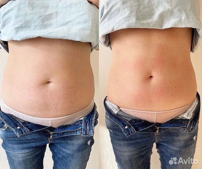 Коррекция фигуры Липосоникс -3см за одну процедуру