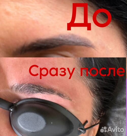 Лазерное удаление тату/татуажа/пм