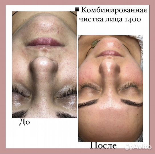 Косметолог. Пирсинги. Перманент, RF-лифтинг