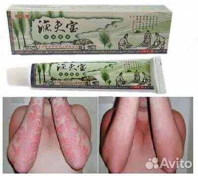 Мазь от псориаза