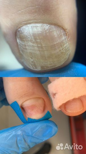 Подолог, медицинский педикюр, титановая нить