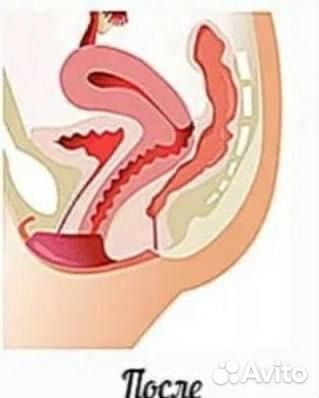 Интимное востановление-омоложение