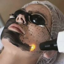 Карбоновый пилинг лица