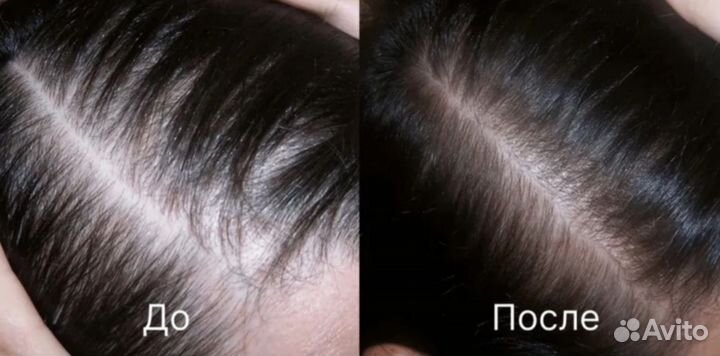 Восстановление роста и густоты волос