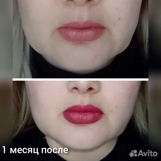 Морщин нет. Подтяну овал,веки. Смас-лифтинг