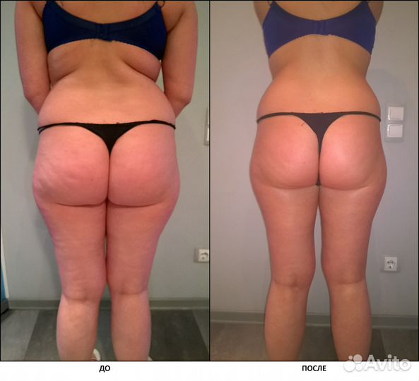 Антицеллюлит. вакуумный массаж тела,лица,кавитация