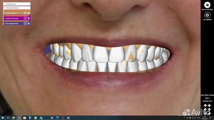 Удалённое моделирование в exocad