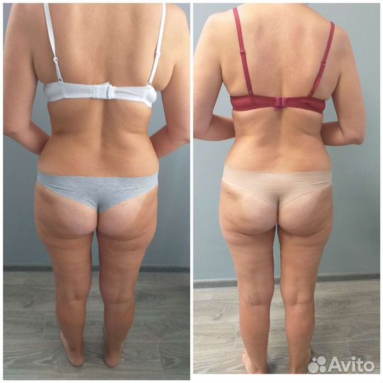 Аппаратный массаж LPG