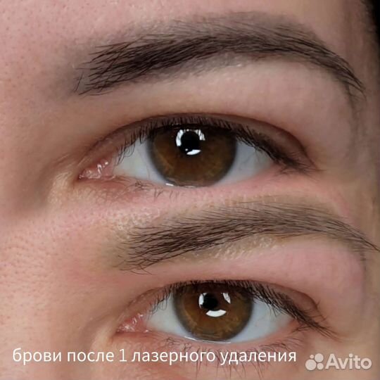 Удаление татуажа.Карбоновый пилинг.Обучение