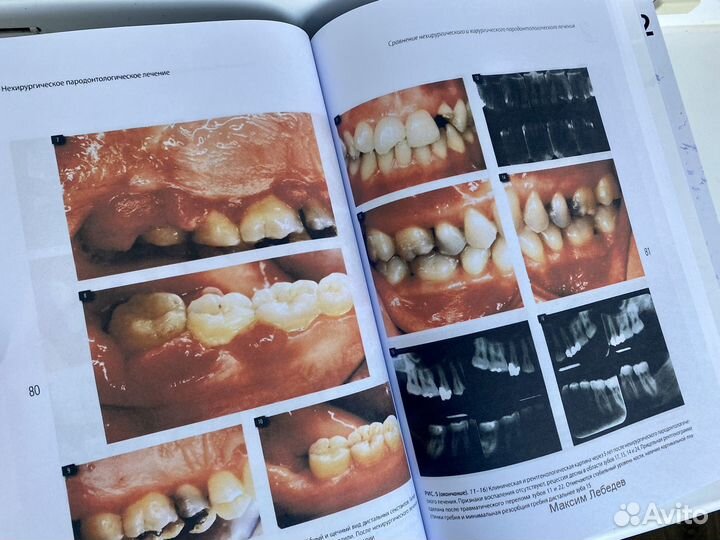 Диагностика и лечение заболеваний пародонта