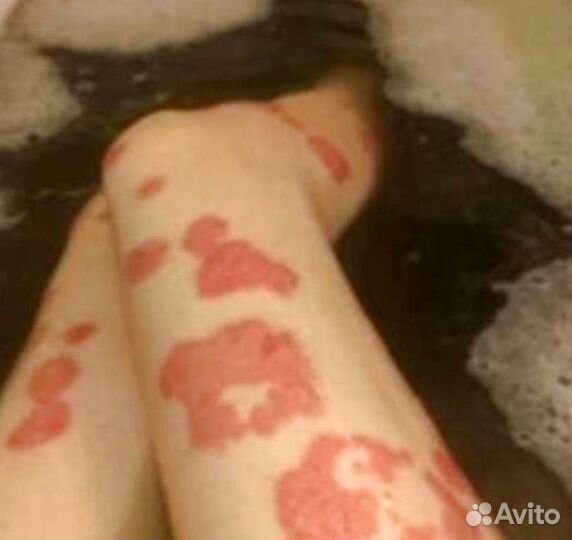 Мазь от псориаза