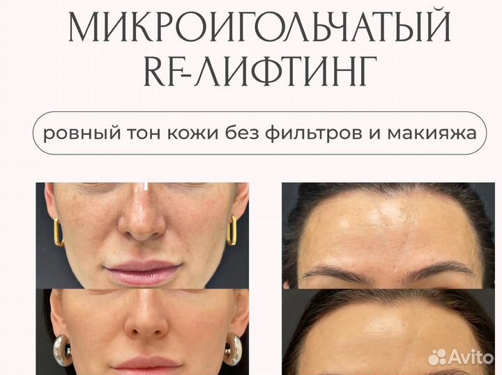 Микроигольчатый RF лифтинг в Симферополое