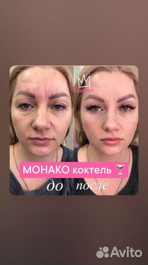 Косметолог. Губы. Ботокс