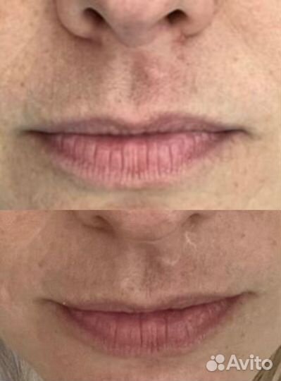 Камуфляж рубцов/растяжек/ареол