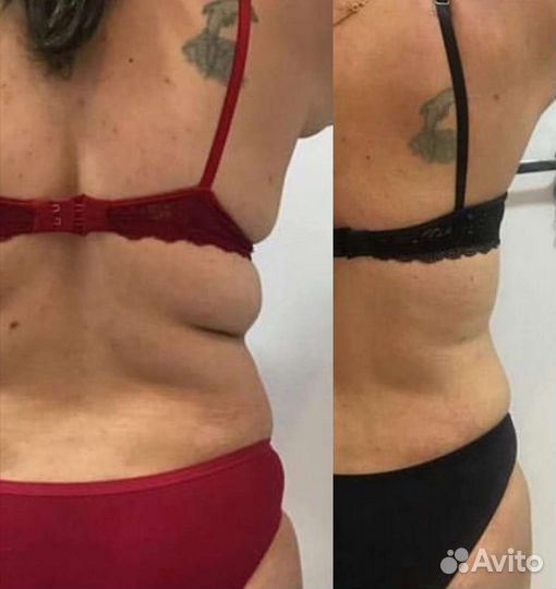 Антицеллюлитный массаж. Кавитация.RF-лифтинг