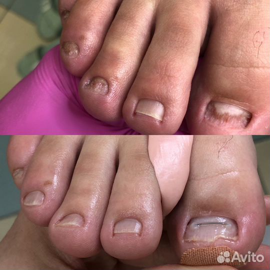 Подолог, вросший ноготь, мозоли