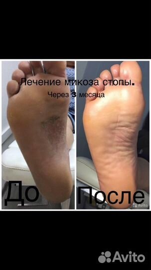 Медицинский педикюр,маникюр выезд на дом