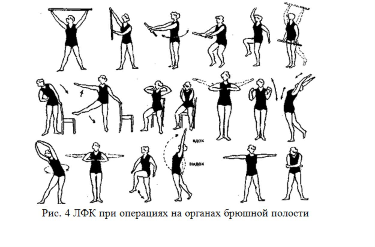 Физические упражнения после. ЛФК при мастэктомии комплекс упражнений. Комплекс упражнений при лимфостазе руки после мастэктомии. ЛФК после операции мастэктомии. ЛФК при ВСД комплекс упражнений.